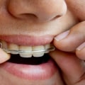 How Long Should You Wear a Retainer After Orthodontic Treatment?